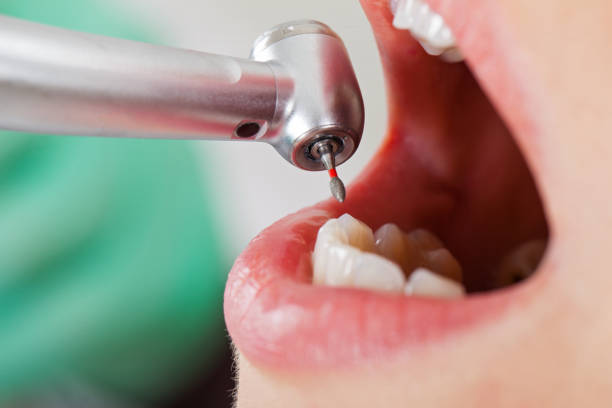 Best Emergency Dentist for Knocked-Out Tooth in Cosmopolis, WA